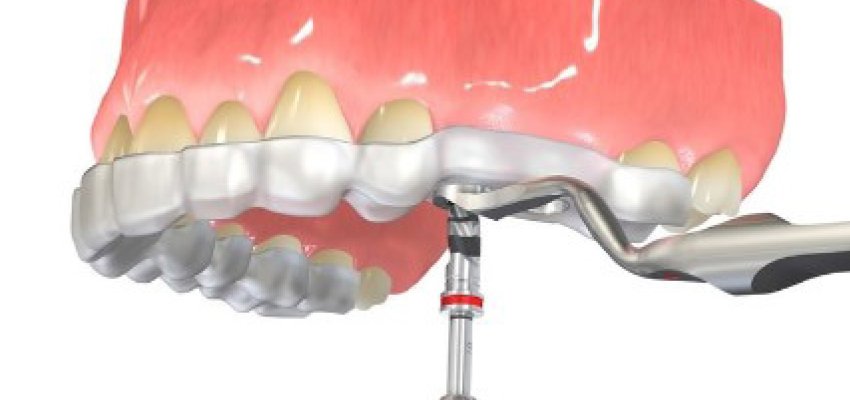 cirurgia-de-implantes-dentarios-guiada-por-computador-01102019145534