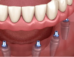 tipos-de-implantes-dentarios-fotos-1